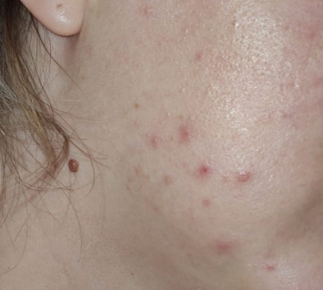 La Roche Posay Effaclar Ultra Concentrated Serum Προσώπου με AHA & Σαλικυλικό Οξύ για Ακμή & Ατέλειες 30ml
