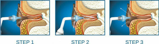 Bionix OtoClear Συσκευή Πλύσεως Αυτιών