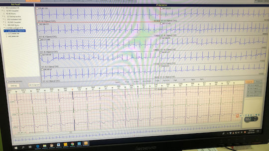 Borsam ECG Patch Holter Ρυθμού 3 Απαγωγών