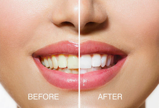 Rio Smile White Advanced Blue-Light Teeth Whitening