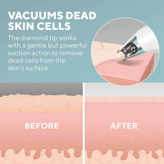 Homedics Remove Microderm Cooling Συσκευή Περιποίησης Προσώπου