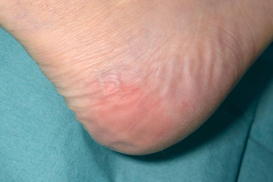 Behrend Heel Pad Schutz für Untere Gliedmaßen Belüfteter Unterflügel für Abfahrten