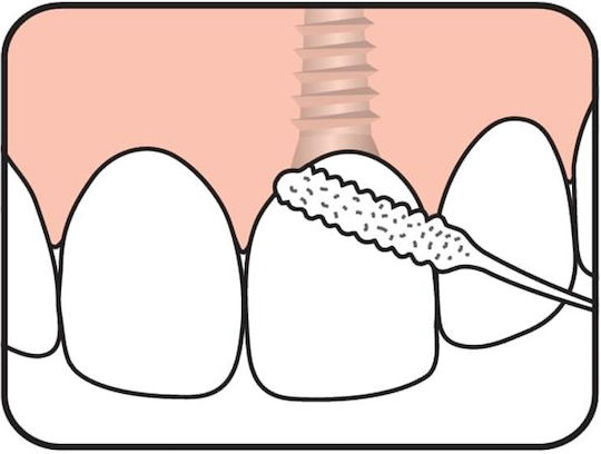 Te Pe Bridge Implant Floss Νήμα Καθαρισμού Γεφυρών & Εμφυτευμάτων 30 Τεμάχια