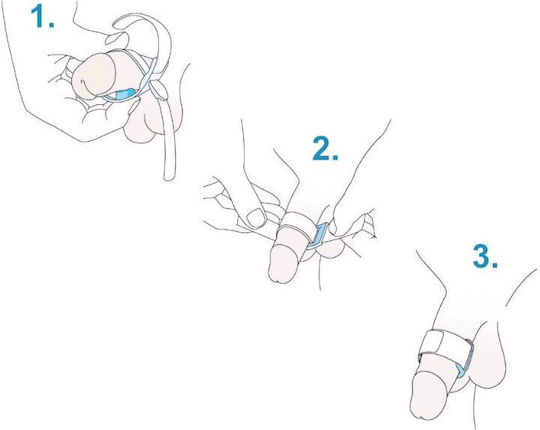 Tape Against Urinary Incontinence In Men Prosecca Medintim
