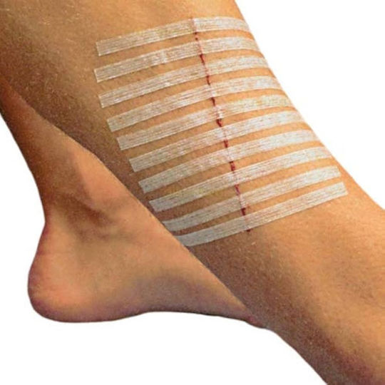 Rudastrip Wound Suture Strips 6mm X 100mm 1 Envelope 10 Strips