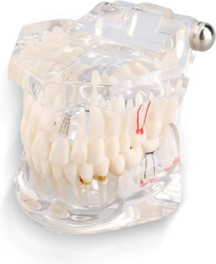 Dental Demonstration Model Ubx Mobilizable Teeth Implants Restorations Dental Pathologi