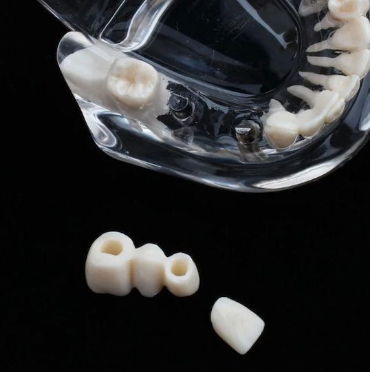 Dental Demonstration Model Ubx Mobilizable Teeth Implants Restorations Dental Pathologi