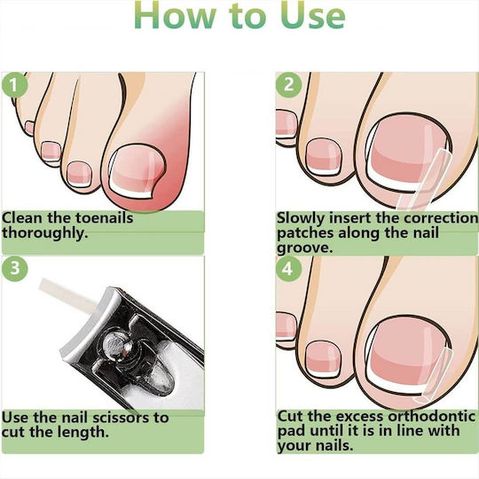 Ingrown Toenail Correction Liner Splint