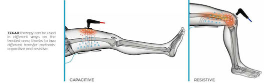 I-Tech Tecar CR 200 Physiotherapy Device