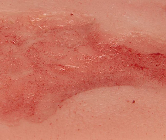 Kleines venöses Beingeschwür Wunde Phase Epithelisierung Erler Zimmer