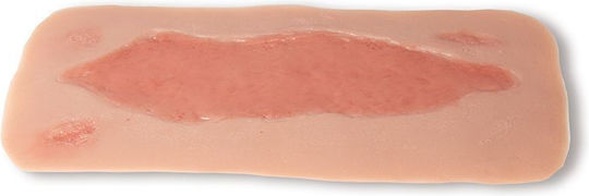 Large Arterial Ulcer Foot Wound Epithelium Phase Erler Zimmer
