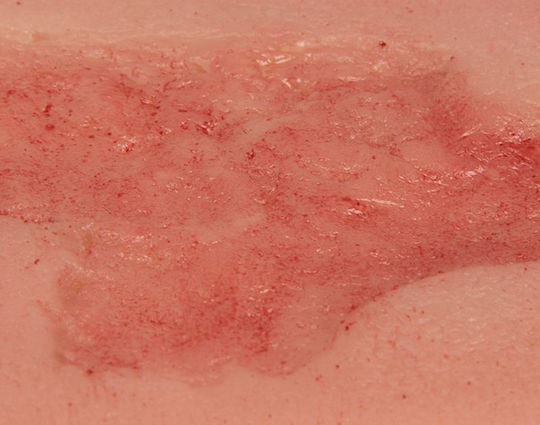 Small Arterial Ulcer Foot Wound Epithelium Phase Erler Zimmer