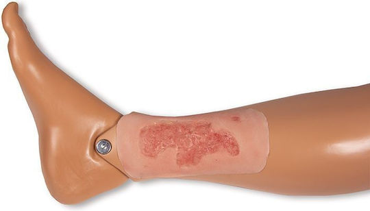 Small Arterial Ulcer Foot Wound Epithelium Phase Erler Zimmer