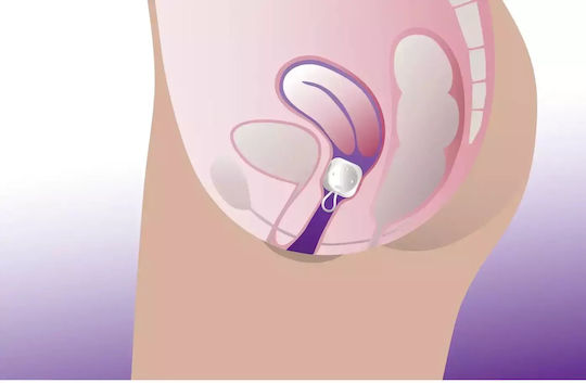 ProFem Vaginal-Pessar Cube Pessary ohne Οπές Ohne Löcher