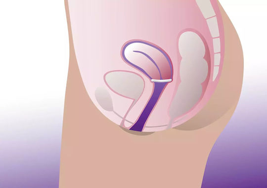 ProFem RingS Vaginal-Pessar 102mm 102mm