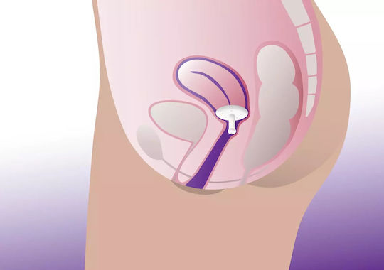 ProFem Gellhorn Vaginal-Pessar 63mm 63mm
