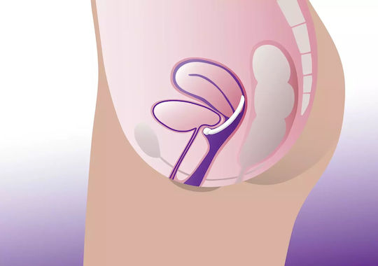 Vaginalpessar Ringpessar Knopfstütze Profem