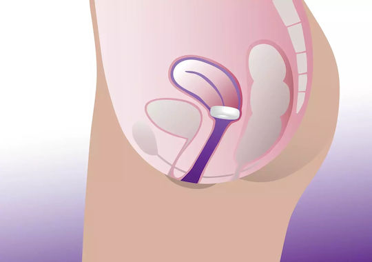 Pesariu vaginal tip inel Profem