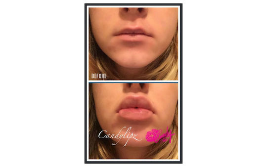 CandyLipz Mini Cherry Pompa Pentru Mărirea Buzele 1 Bucată