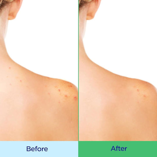 Differin Gel De Duș Cu Acid Salicilic (BHA) Pentru Controlul Sebumului 295ml