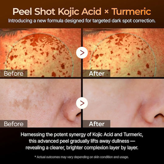 Dr. Melaxin Peel Shot Exfoliating Kojic Acid Turmeric Moisturizing Face Serum with Niacinamide & AHA for Brightening & Dark Spots 80ml