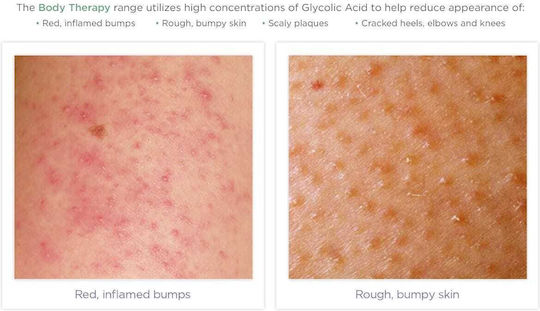 Glytone Exfoliant pentru Picioare, Mâini, Față și Corp 250ml