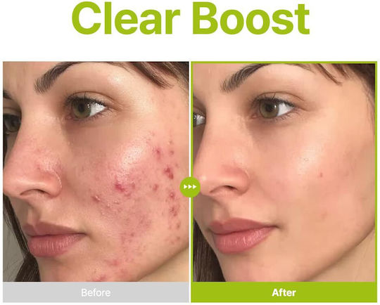 Azelaic Acid 10 Kojic Tea Tree Serum Face for Whitening & Acne 30ml