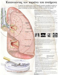Ανατομικός Χάρτης: Κατανοώντας τον Καρκίνο του Πνεύμονα