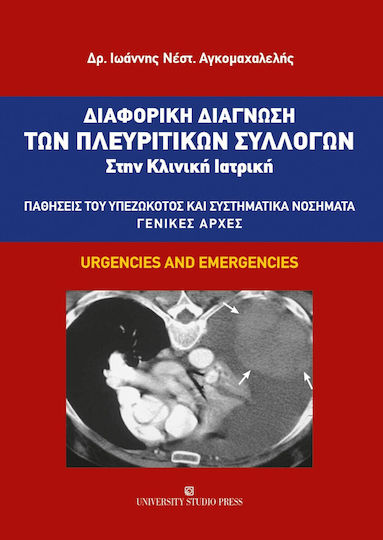 Διαφορική Διάγνωση των Πλευριτικών Συλλογών στην Κλινική Ιατρική Διαφορική Διάγνωση των Πλευριτικών Συλλογών στην Κλινική Ιατρική