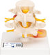 Прототип Остеен Отдел На Гръбначния Стълб Пролапс На Междупрешленен Диск 1000149